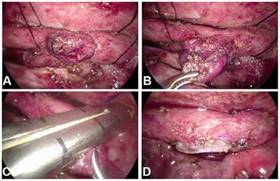 Thoracoscopy for Esophageal Diverticula After Esophageal Atresia With Tracheo-Esophageal Fistula